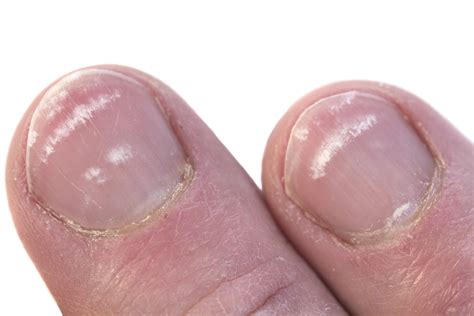 leukonychia spots result from _____.